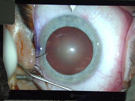 Aufgezeigt Wartezeiten Augenoperation Grauer Star